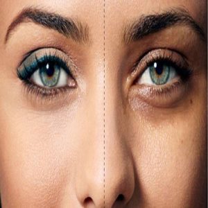درمان سیاهی دور چشم با کمک طب سنتی | با سیاهی دور چشم خداحافظی کنید !!